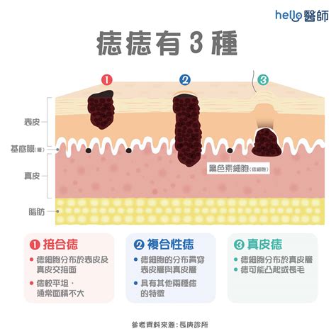 長毛的痣|痣變大、痣多或長毛會變皮膚癌？認識痣的形成與原因